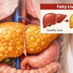 Fatty Liver क्यों होता है? कारण, लक्षण और असरदार उपाय